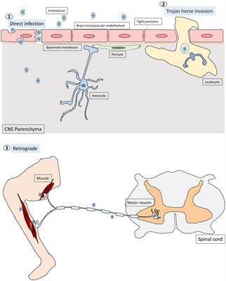 Enterovirus and Encephalitis